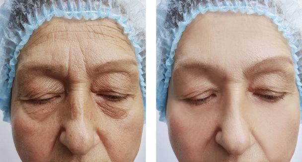 Yaşlı kadın kırışıklıkları yüz öncesi ve sonrası yordamları, etkisi - Fotoğraf, Görsel