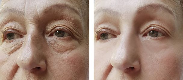 Yaşlı kadın kırışıklıkları yüz öncesi ve sonrası yordamları, etkisi - Fotoğraf, Görsel