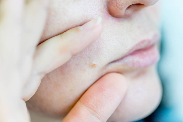 a birthmark or a mole on a woman skin - Foto, afbeelding