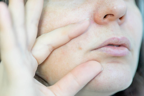 a birthmark or a mole on a woman skin - Photo, Image