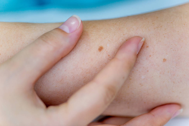 a birthmark or a mole on a woman skin - Foto, afbeelding
