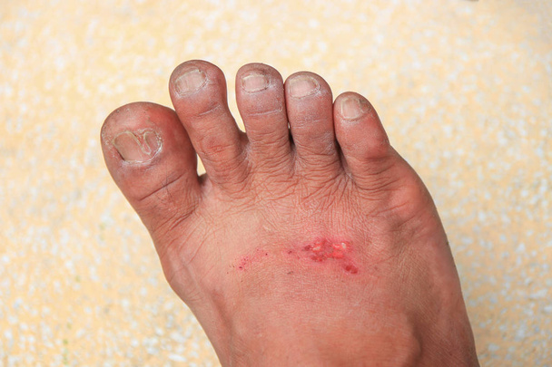 Fußwunde infiziert sich mit geringer Schärfentiefe. - Foto, Bild