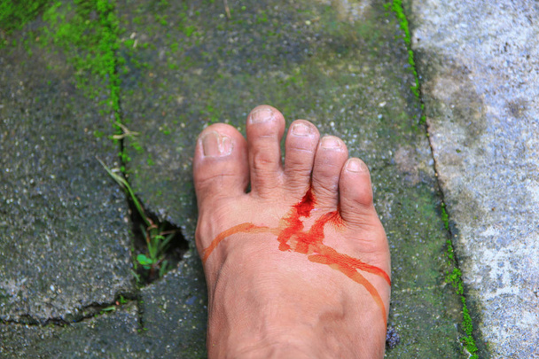 blessure au pied devient infecté par l'application de médicaments sélectionner la mise au point avec une faible profondeur de champ
. - Photo, image