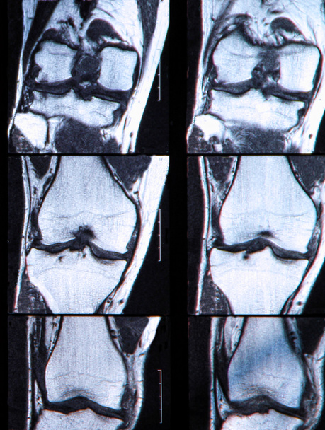 X-Ray image if the human knee - Photo, Image