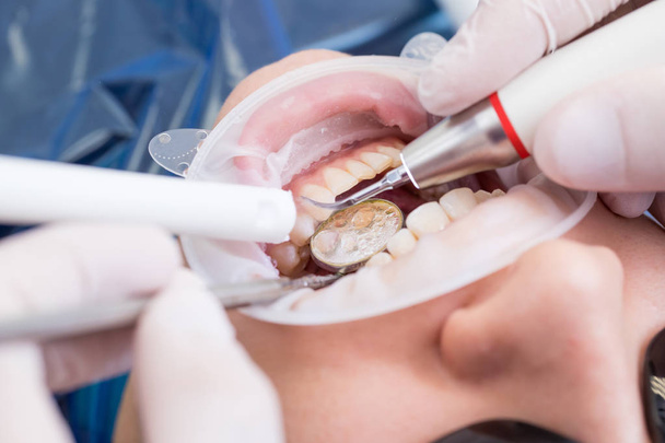 Closeup of modern professional teeth cleaning in dentistry with specialized equipment. The patient is wearing a retractor - Φωτογραφία, εικόνα