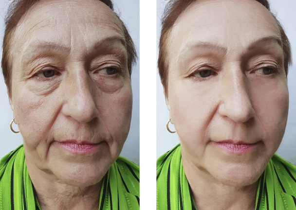 Ρυτίδες προσώπου ηλικιωμένη γυναίκα πριν και μετά από διαδικασίες - Φωτογραφία, εικόνα
