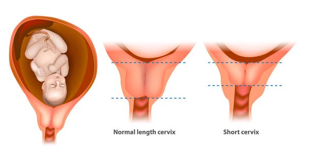Normal length cervix and short cervix in Pregnancy. The cervix or cervix uteri - Vector, Image