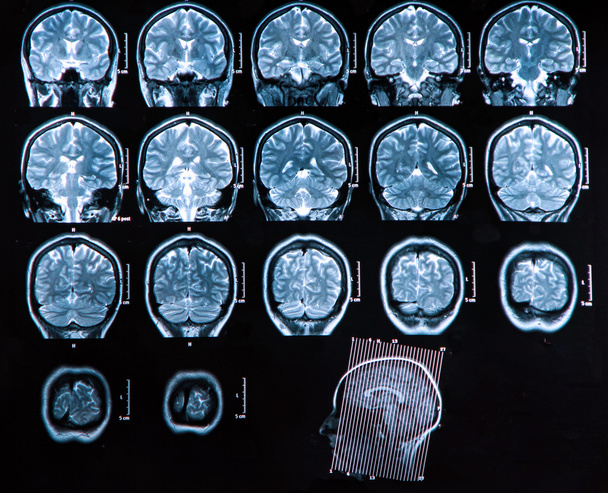 MRI mózgu skanowania - Zdjęcie, obraz