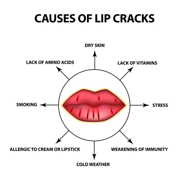 リップのひびの原因。口の隅に亀裂。インフォ グラフィック。孤立した背景のベクトル図 - ベクター画像