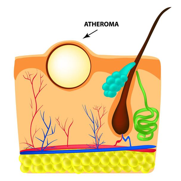 Atheroma structure. The structure of moles on the skin. Infographics. Vector illustration on isolated background - Vector, Image