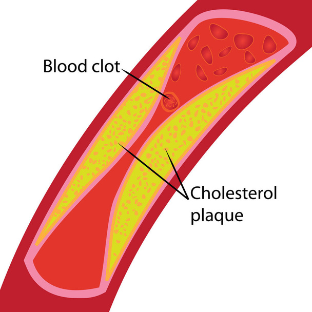 Blood clot and cholesterol plaque. Blocked blood vessel illustration - Vector, Image