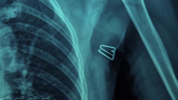 MRI skenování zlomil klíční kost (zlomené klíční kosti), lidské tělo Xray Monitor - Záběry, video