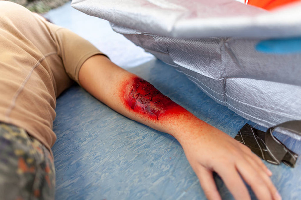 bendaggio di pronto soccorso sulla vittima ferita bruciata
 - Foto, immagini