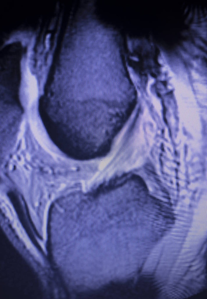 Obrazowanie rezonansu magnetycznego Mri kolana tylnego rogu łąkotki przyśrodkowej łza scantest wyniki. - Zdjęcie, obraz