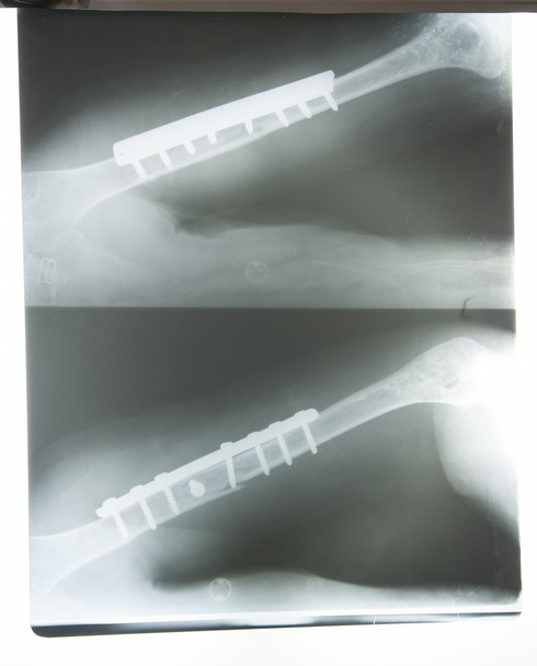 Zdjęcie rentgenowskie złamaną rękę - Zdjęcie, obraz
