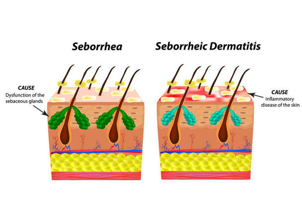 Causes Seborrhea skin and hair. Dandruff seborrheic dermatitis. Eczema. Dysfunction of the sebaceous glands. Inflammatory skin disease. Anatomical structure. Infographics. Vector illustration. - Vector, Image