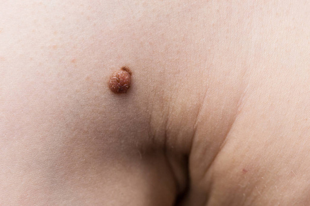 Unrecognizable person having dark fibroma, dermatology problem on skin. Close up of papilloma dermatosis - Φωτογραφία, εικόνα