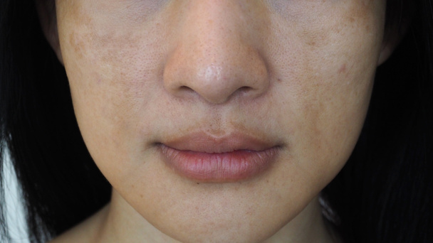 Close-up van Aziatische vrouw met donkere plekjes en sproeten problemen. - Foto, afbeelding