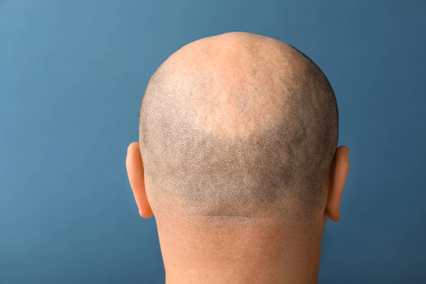 Man with hair loss problem on color background - Photo, Image