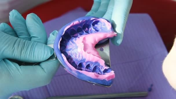 Zahnarzt fertigt Gips für Prothesen an - Filmmaterial, Video