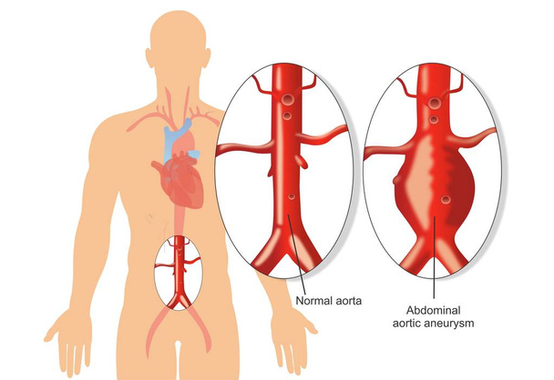 Diagram aneurysmatu břišní aorty - Vektor, obrázek