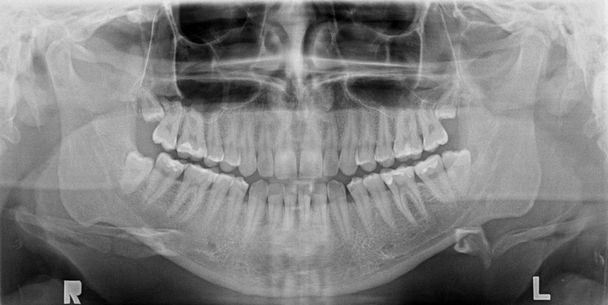 Panoramic x-ray image of teeth - Photo, Image