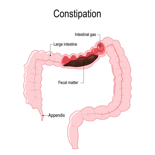 便秘。ベクトル図は、糞便と腸のガスの泡人間の大腸を表しています。生物、科学、および医療用のイラスト. - ベクター画像