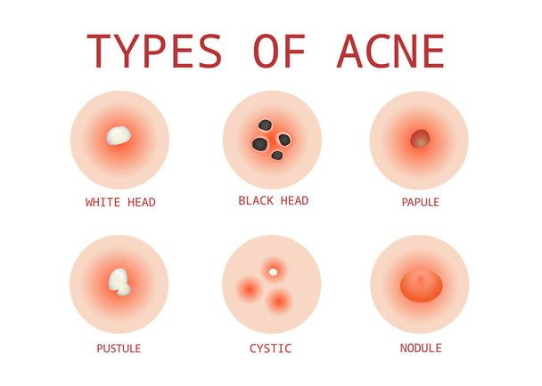 6 types d'acné, vecteur
 - Vecteur, image