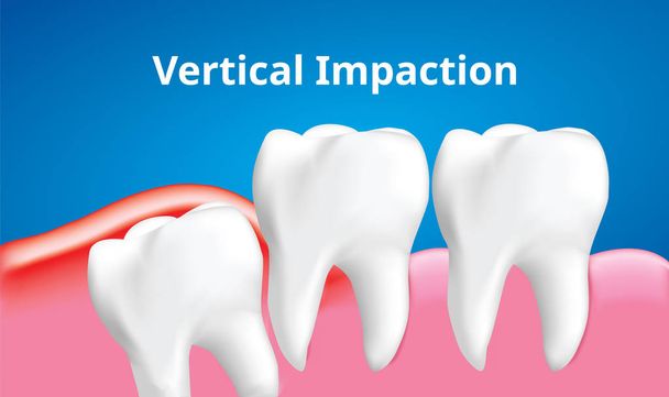 Dente de sabedoria (Impacção vertical) com inflamação afetar, Conceito de cuidados dentários, ilustração realista Vector
 - Vetor, Imagem
