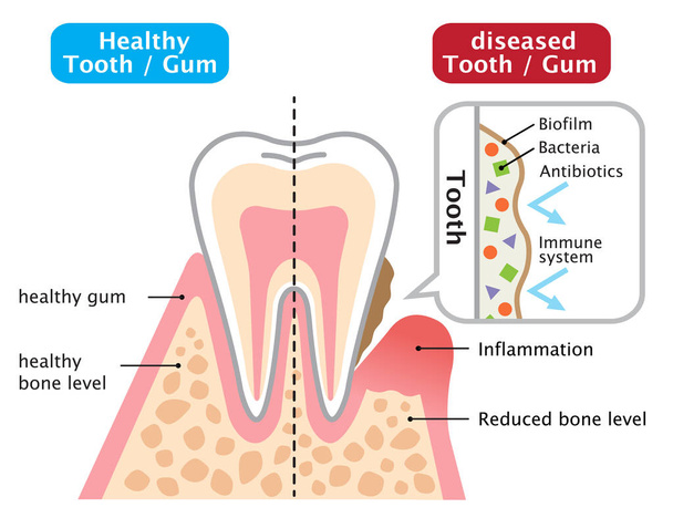 healthy and diseased gum. oral biofilm. dental and health care concept - Vector, Image
