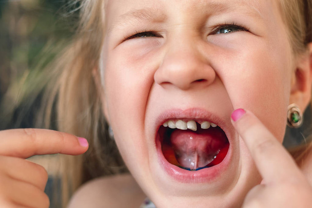 La bambina punta il dito contro un dente traballante. - Foto, immagini