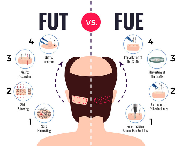 Μεταμόσχευση μαλλιών Fut Vs Fue  - Διάνυσμα, εικόνα