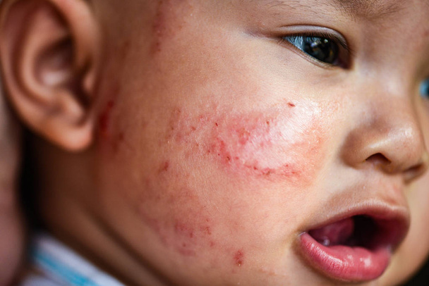 alergii dziecka wysypka na twarzy / choroby dziecko dziewczyna twarz suchość, swędzenie skóry i uszkodzenia spowodowane od alergii u noworodka baby Azji  - Zdjęcie, obraz