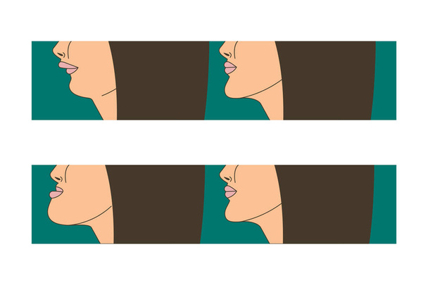 MeziaÂ lnõÂ a distral kousnutí, Žena s malocclusion, dolní čelist protaženo směrem dopředu, kousnutí korekce ve složených závorkách. Vektorové ilustrace - Vektor, obrázek