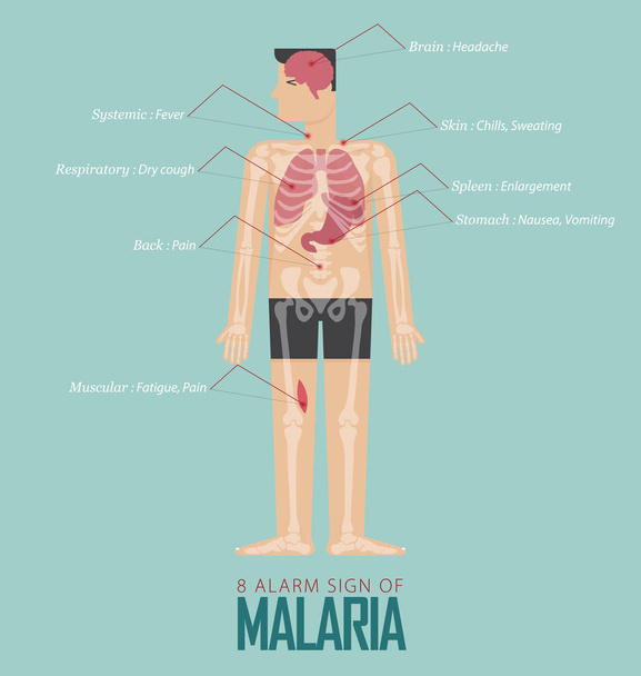 Hälytysmerkkejä malarian infografian litteä muotoilu. Malaria tauti oire kuvake asetettu ihmisen kehon, luuranko ja urut. Vektorikuvaus
. - Vektori, kuva
