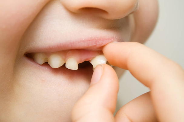 De babymeisje glimlachend en schudden wiebelende melk tand in open mond met haar vinger. Eerste molaire tanden. Gezondheidszorg, mondhygiëne en jeugd concept. - Foto, afbeelding