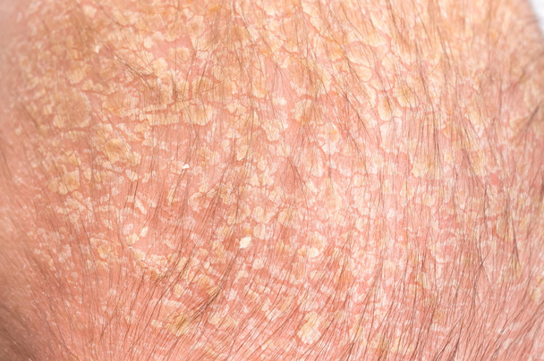 Little newborn baby with psoriasis or dandruff in the hair - Photo, Image