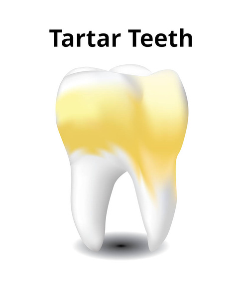 Beyaz arka plan üzerinde gerçekçi tasarlamak vektör izole Tartar diş. - Vektör, Görsel