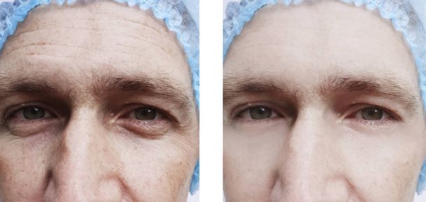 rughe del viso di un uomo prima e dopo le procedure
 - Foto, immagini