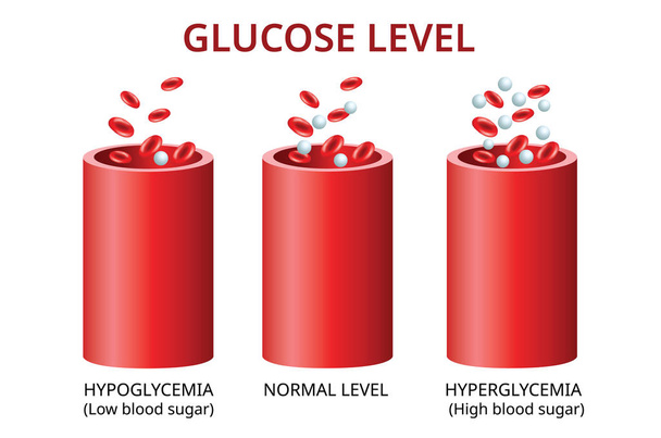 Glukosespiegel im Blutgefäß, normaler Spiegel, Hyperglykämie (hoher Blutzucker), Hypoglykämie (niedriger Blutzucker) Vektordarstellung - Vektor, Bild