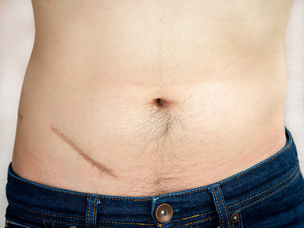 Adam bir yara apandisit ameliyatı izi ile mide gösterilen closeup. - Fotoğraf, Görsel