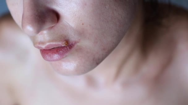 Beautiful young woman with problematic skin suffering from herpes on her chapped lips. Lip treatment and cosmetology concept. - Filmagem, Vídeo