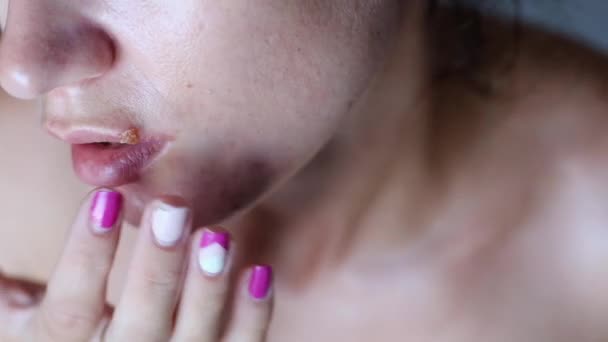 Giovane donna con pelle problematica toccare piaghe da herpes sulle labbra screpolate. Concetto di trattamento labbra
. - Filmati, video