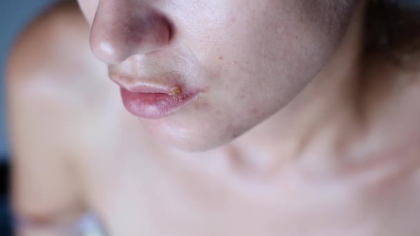 Chica sufre de herpes en sus labios
 - Metraje, vídeo