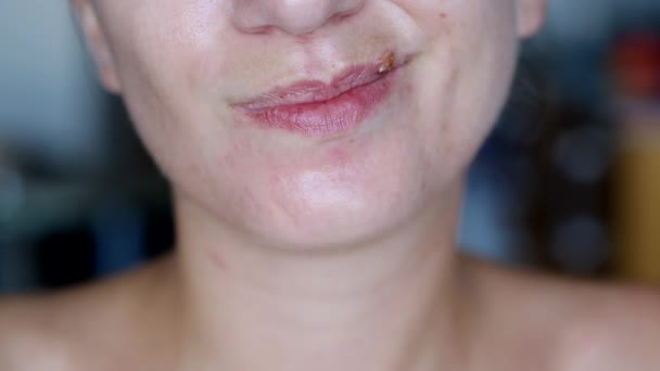 Girl touches herpes on her lips - Footage, Video
