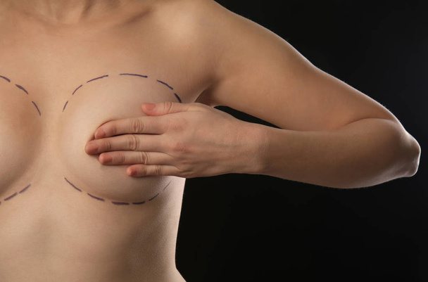Νεαρή γυναίκα με σημάδια στο στήθος για την αισθητική χειρουργική λειτουργία σκούρο φόντο - Φωτογραφία, εικόνα