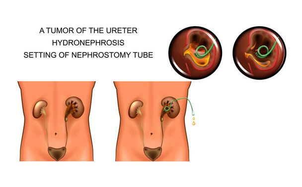 Vector εικονογράφηση του όγκου του ουρητήρα. υδρονέφρωση. η ρύθμιση του nephrostomy σωλήνα - Διάνυσμα, εικόνα