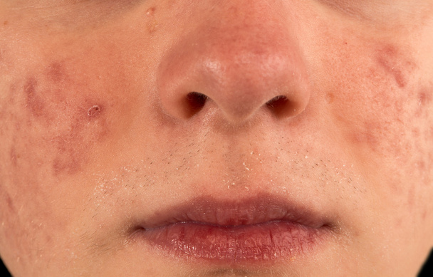 ernstige acne - Foto, afbeelding