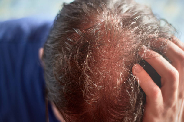 Cuir chevelu de jeune homme caucasien vu d'en haut et présentant un problème de perte de cheveux
. - Photo, image