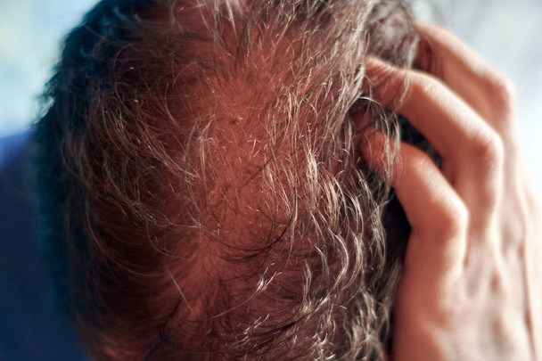 cuero cabelludo de hombre caucásico joven visto desde arriba y mostrando un problema de pérdida de cabello
. - Foto, Imagen